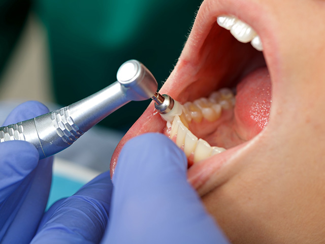 むし歯と歯周病の予防 