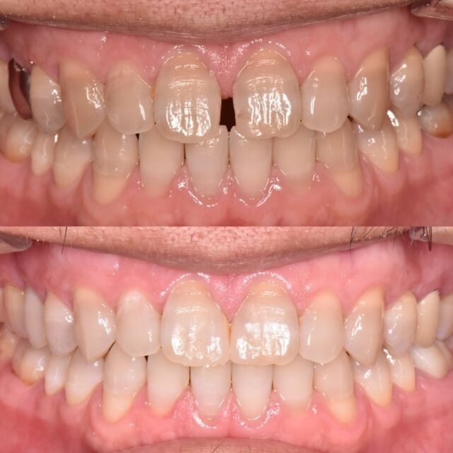こんにちはくまざきデンタルクリニックです✨

ホワイトニング、セラミッククラウン、すきっ歯のダイレクトボンディングを行ったbefore & after です😊

もともとの歯の色が濃い色でしたのでホワイトニング後、上の前歯のすきっ歯に対しては、歯を削らないダイレクトボンディングより歯科用樹脂を貼り付けました🦷

また、奥歯の銀歯に対してはセラミッククラウンを装着しています✨

当院では様々な治療を取り入れて、それぞれのメリットとデメリットをお話しした上で治療を行っております、ぜひご相談ください☺ 

#歯科医院  #歯科 #歯科医院開業 #名古屋市歯科  #千種区 #覚王山 #池下 #今池 #桜通線 #東山線 #池下駅 #広小路通 #インプラント #審美歯科  #ホワイトニング  #マイクロスコープ  #小児歯科  #矯正歯科 #マウスピース矯正  #小児矯正 #アライナー矯正  #女性歯科医師在籍 #ダイレクトボンディング  #根管治療  #minimalinvasivedentistry  #くまざきデンタルクリニック
